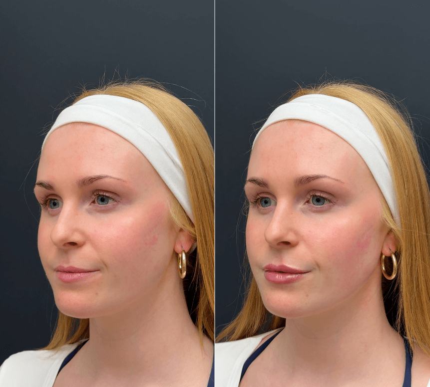 Side-by-side comparison of a Face Forward Aesthetics guest before and after JUVÉDERM lip filler treatment