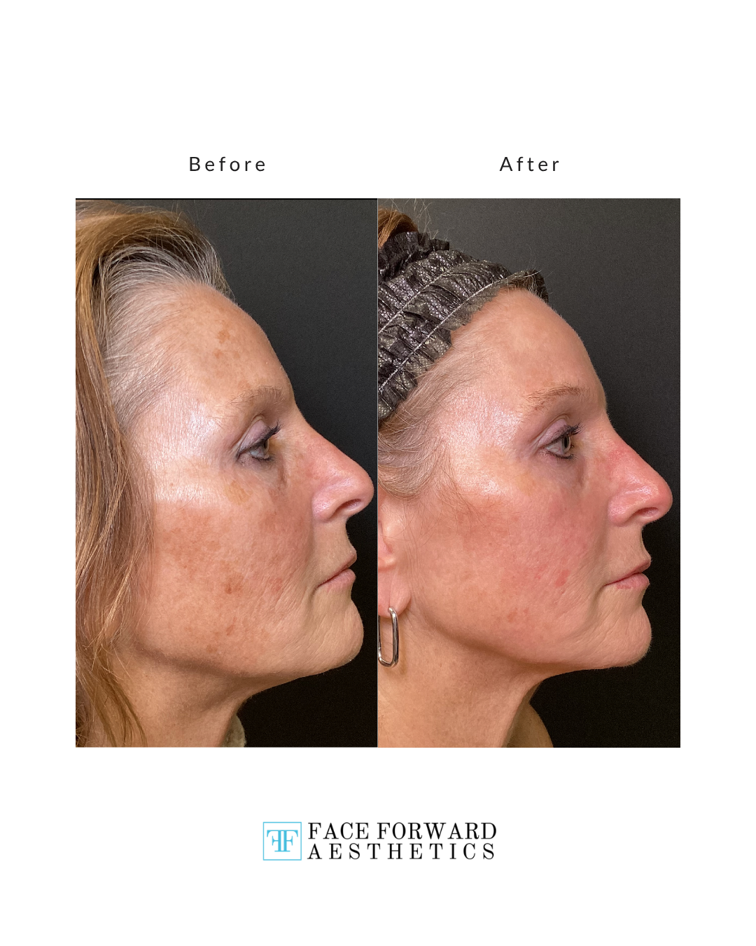 Before + After Template (4)