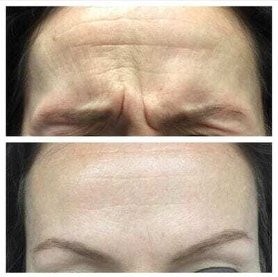 botox in Las Vegas