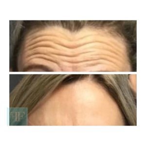 botox for forehead wrinkles