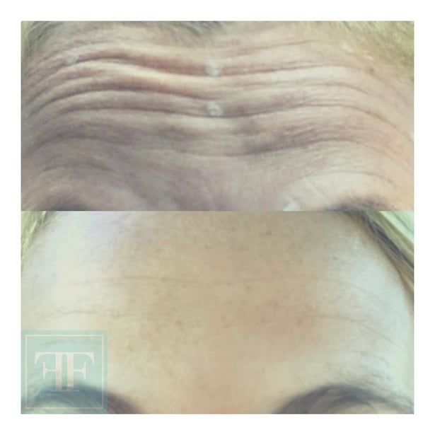 Botox in Pittsburgh