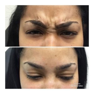 Botox before and after