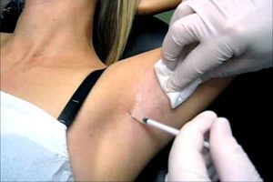 hyperhidrosis treatment armpits