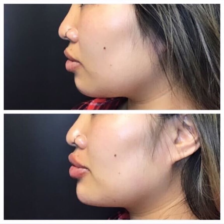 chin filler