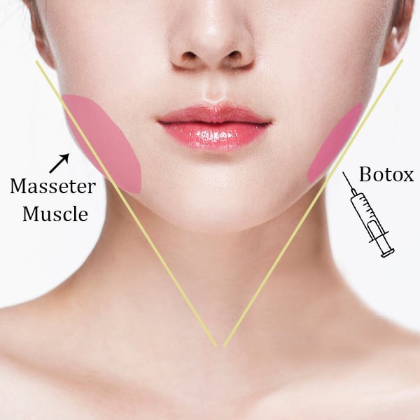botox masseter muscles