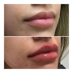 lip filler Pittsburgh Pennsylvania