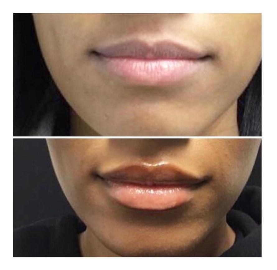 lip filler Pittsburgh