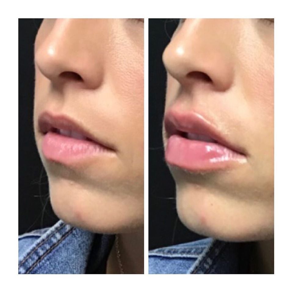 juvederm ultra plus lip filler