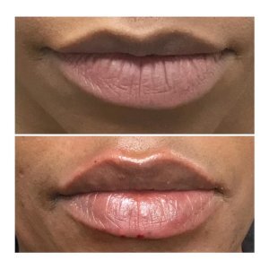 lip filler Pittsburgh 