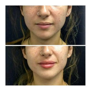lip filler 