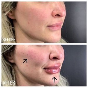 cheek filler 