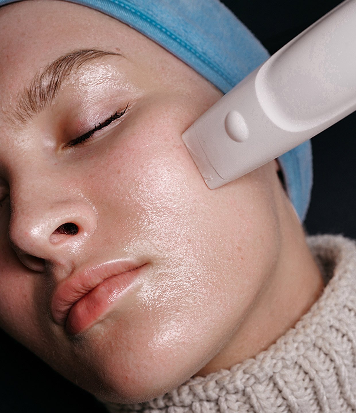 radio frequency microneedling